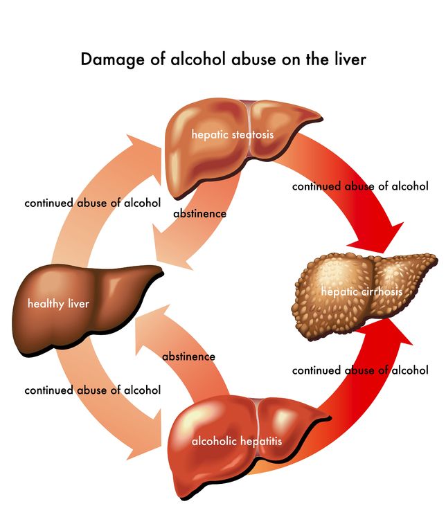 Alcoholic Liver Disease Treatment In Israel D R A Medical