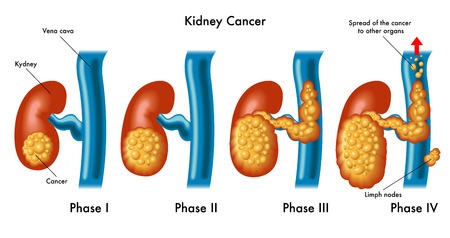 Kidney Cancer - Treatment in Israel | D.R.A Medical